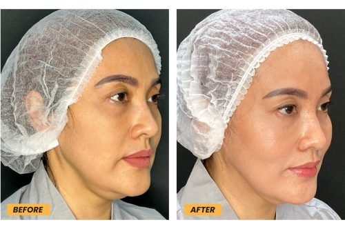 SmartXide adalah salah satu perawatan kecantikan yang menggunakan teknologi laser untuk mengatasi berbagai masalah kulit.